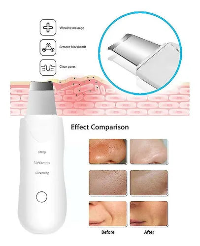 Espatula Facial Ultrasonica Exfoliante